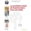 Image de La prothèse totale de hanche dans tous ses états