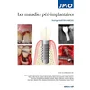 Image de Les maladies péri-implantaires